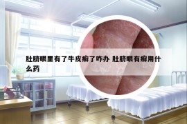 肚臍眼里有了牛皮癬了咋辦 肚臍眼有癬用什么藥