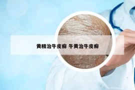 黃精治牛皮癬 牛黃治牛皮癬