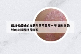 四川省最好的皮膚科醫(yī)院是那一所 四川省最好的皮膚醫(yī)院是哪家