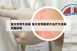 復(fù)方甘草牛皮癬 復(fù)方甘草酸苷片治療牛皮癬效果好嗎
