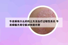 牛皮癬有什么好的土方法治療過敏性鼻炎 牛皮癬偏方用它解決快捷方便