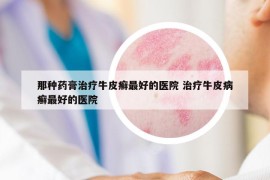 那種藥膏治療牛皮癬最好的醫(yī)院 治療牛皮病癬最好的醫(yī)院