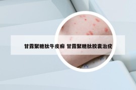甘露聚糖肽牛皮癬 甘露聚糖肽膠囊治疣