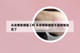 頭皮銀屑病是廯嗎 頭皮銀屑病是不是很難治愈了