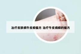 冶療皮膚病牛皮癬偏方 治療牛皮病癬的偏方
