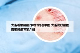 大連看銀屑病口碑好的老中醫(yī) 大連皮膚病醫(yī)院銀屑病專(zhuān)家介紹