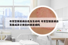 尋常型銀屑病會危及生命嗎 尋常型銀屑病會發(fā)展成其它類型的銀屑病嗎