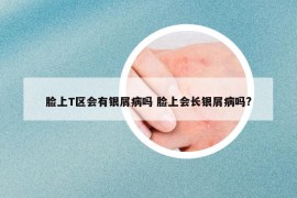 臉上T區(qū)會(huì)有銀屑病嗎 臉上會(huì)長(zhǎng)銀屑病嗎?
