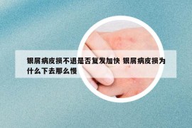 銀屑病皮損不退是否復發(fā)加快 銀屑病皮損為什么下去那么慢