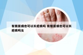 有銀屑病也可以長(zhǎng)疤痕嗎 有銀屑病也可以長(zhǎng)疤痕嗎女