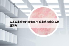 頭上頭皮癬好的癥狀圖片 頭上頭皮癬怎么快速消失