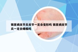 銀屑病關(guān)節(jié)炎關(guān)節(jié)一定會(huì)變形嗎 銀屑病關(guān)節(jié)炎一定會(huì)癱瘓嗎