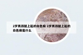 2歲男孩腿上起的白色癬 2歲男孩腿上起的白色癬是什么