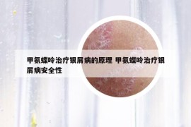 甲氨蝶呤治療銀屑病的原理 甲氨蝶呤治療銀屑病安全性