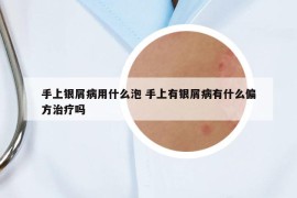 手上銀屑病用什么泡 手上有銀屑病有什么偏方治療嗎