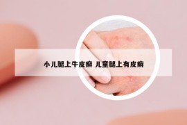 小兒腿上牛皮癬 兒童腿上有皮癬