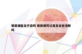 銀屑病能足療店嗎 銀屑病可以用足浴包泡腳嗎