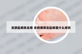 皮膚起癬而且癢 皮膚瘙癢且起癬是什么癥狀