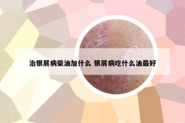 治銀屑病柴油加什么 銀屑病吃什么油最好