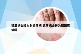 銀屑病會(huì)轉(zhuǎn)為副銀屑病 銀屑病會(huì)轉(zhuǎn)為副銀屑病嗎
