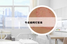 牛皮癬烤燈家用
