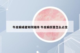 牛皮癬或者如何維持 牛皮癬厲害怎么止住