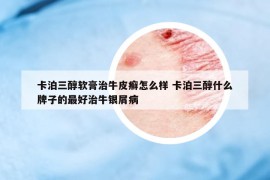 卡泊三醇軟膏治牛皮癬怎么樣 卡泊三醇什么牌子的最好治牛銀屑病
