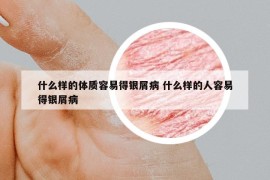 什么樣的體質(zhì)容易得銀屑病 什么樣的人容易得銀屑病