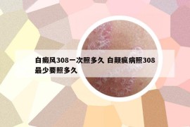白癜風308一次照多久 白顛瘋病照308最少要照多久