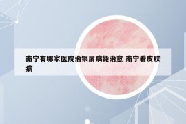 南寧有哪家醫(yī)院治銀屑病能治愈 南寧看皮膚病
