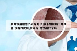 腋窩銀屑病怎么治療方法 腋下銀屑病一片紅色,沒有白皮屑,有點癢,是快要好了嗎