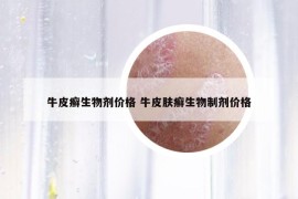 牛皮癬生物劑價格 牛皮膚癬生物制劑價格