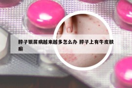 脖子銀屑病越來越多怎么辦 脖子上有牛皮膚癬