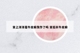 背上洋洋是牛皮癬發(fā)作了嗎 背后長牛皮癬