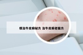 根治牛皮癬秘方 治牛皮癬老偏方
