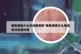 銀屑病選什么的潤膚劑好 銀屑病用什么保濕膏潤皮膚好那