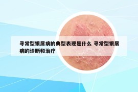 尋常型銀屑病的典型表現(xiàn)是什么 尋常型銀屑病的診斷和治療