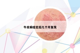 牛皮癬痊愈后幾個月復發(fā)