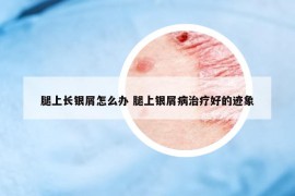 腿上長銀屑怎么辦 腿上銀屑病治療好的跡象