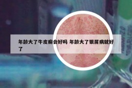 年齡大了牛皮癬會(huì)好嗎 年齡大了銀屑病就好了