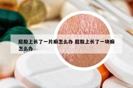 屁股上長(zhǎng)了一片癬怎么辦 屁股上長(zhǎng)了一塊癬怎么辦