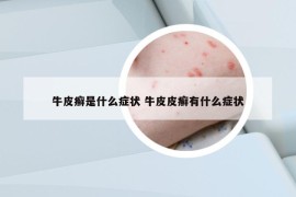 牛皮癬是什么癥狀 牛皮皮癬有什么癥狀