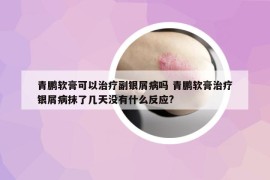 青鵬軟膏可以治療副銀屑病嗎 青鵬軟膏治療銀屑病抹了幾天沒有什么反應(yīng)?