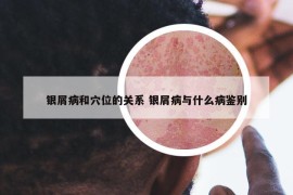 銀屑病和穴位的關(guān)系 銀屑病與什么病鑒別