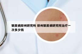 銀屑病鄭州研究所 鄭州銀屑病研究院治療一次多少錢