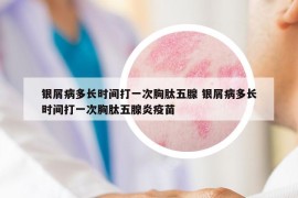 銀屑病多長(zhǎng)時(shí)間打一次胸肽五腺 銀屑病多長(zhǎng)時(shí)間打一次胸肽五腺炎疫苗