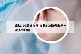 皮膚308激光治療 皮膚308激光治療一次多長(zhǎng)時(shí)間