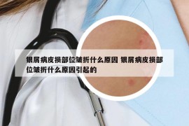 銀屑病皮損部位皺折什么原因 銀屑病皮損部位皺折什么原因引起的
