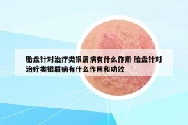 胎盤針對治療類銀屑病有什么作用 胎盤針對治療類銀屑病有什么作用和功效