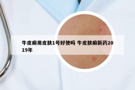牛皮癬用皮膚1號好使嗎 牛皮膚癬新藥2019年